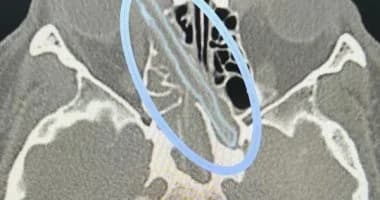 روسيا.. اكتشاف غصناً خشبياً بطول 12 سم داخل جمجمة رجل