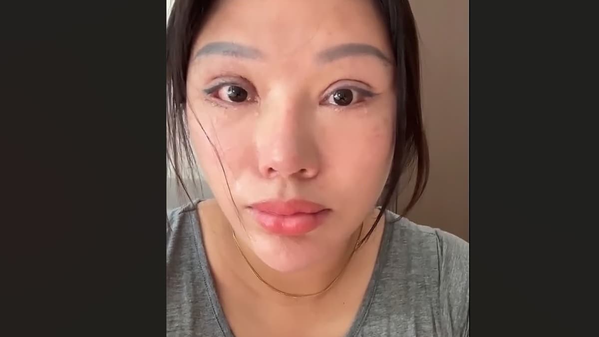 بعد عملية تجميل فاشلة.. طبيبة مزيفة تحرم امرأة من "غمضة العين"
