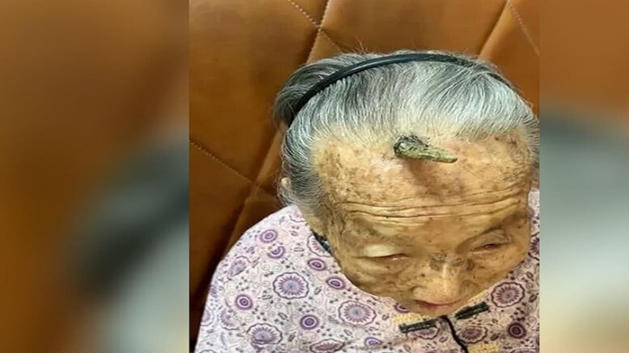 "قرن طول العمر" ينمو على جبهة عجوز صينية