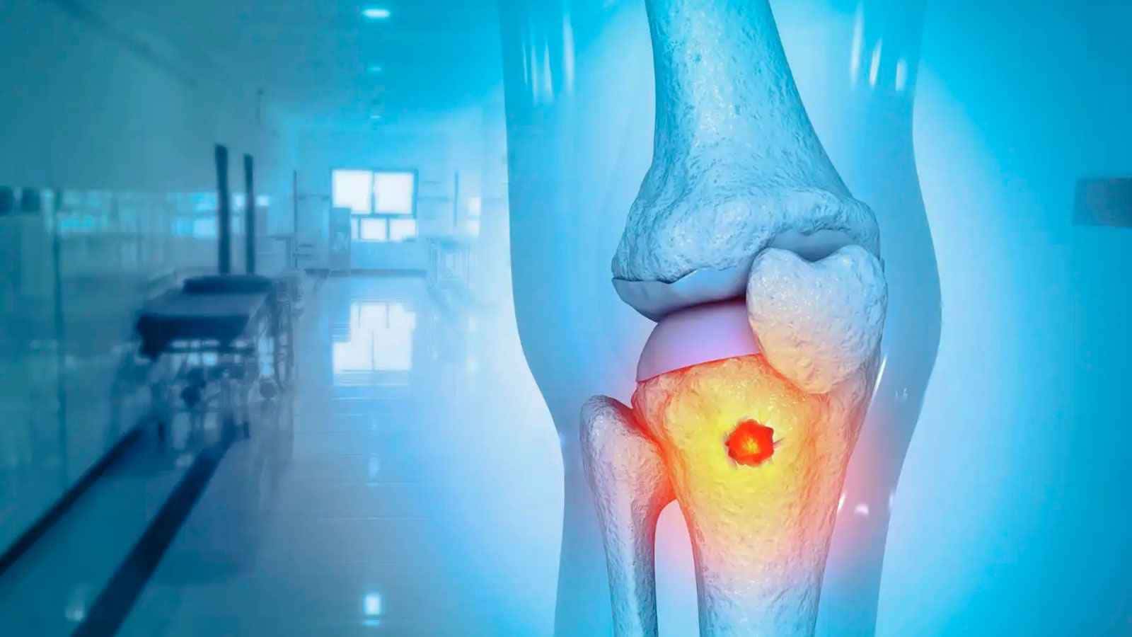 ورم العظام.. أعراض تحذيرية تستدعي الفحص المبكر